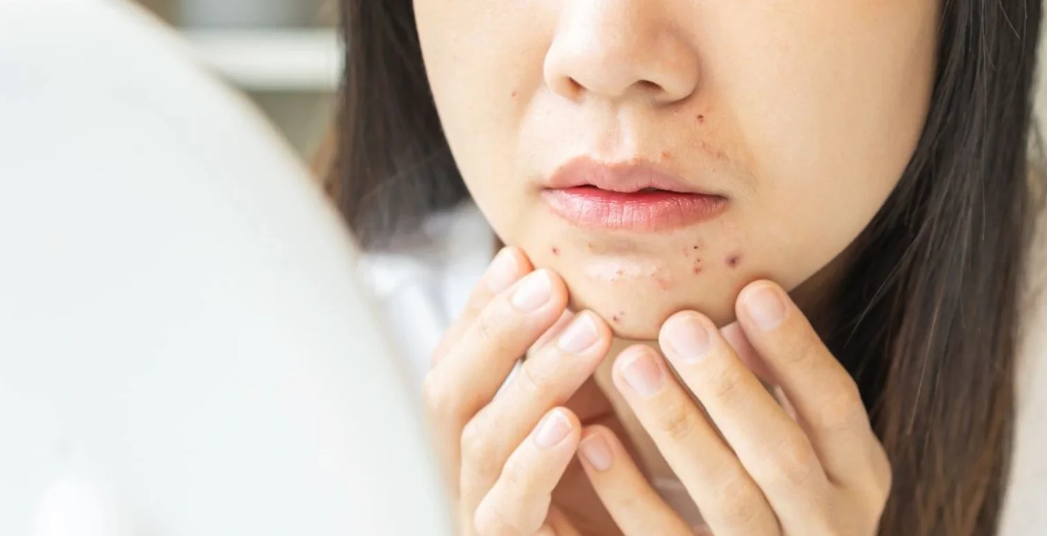 How to Choose the Right Treatment for Acne Scars?